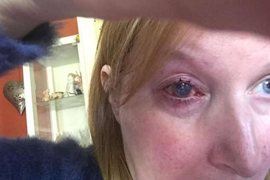 Британке удалили глаз после того, как она занесла инфекцию, принимая душ в линзах