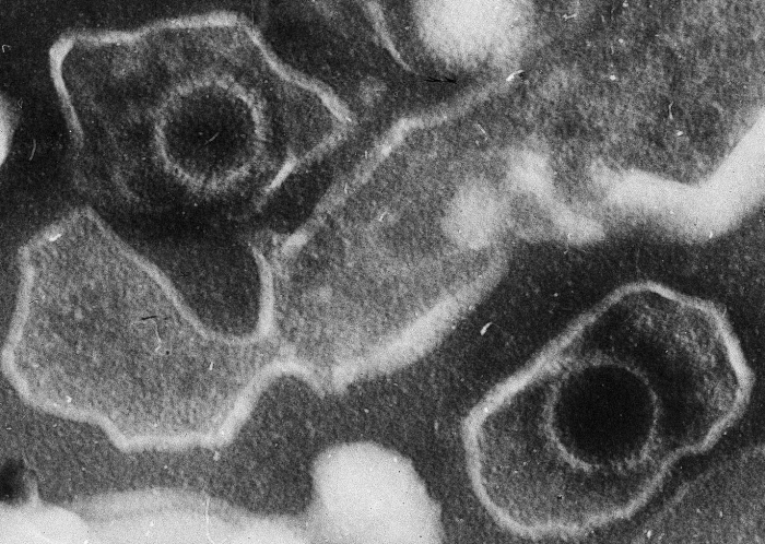 Очень распространенный вирус может стать толчком к развитию рассеянного склероза